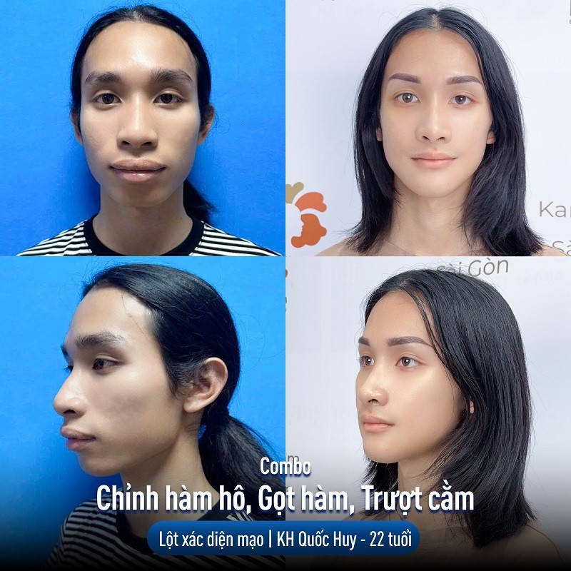 Khách hàng thực hiện trượt cằm tại Kangnam không cảm thấy đau hay khó chịu