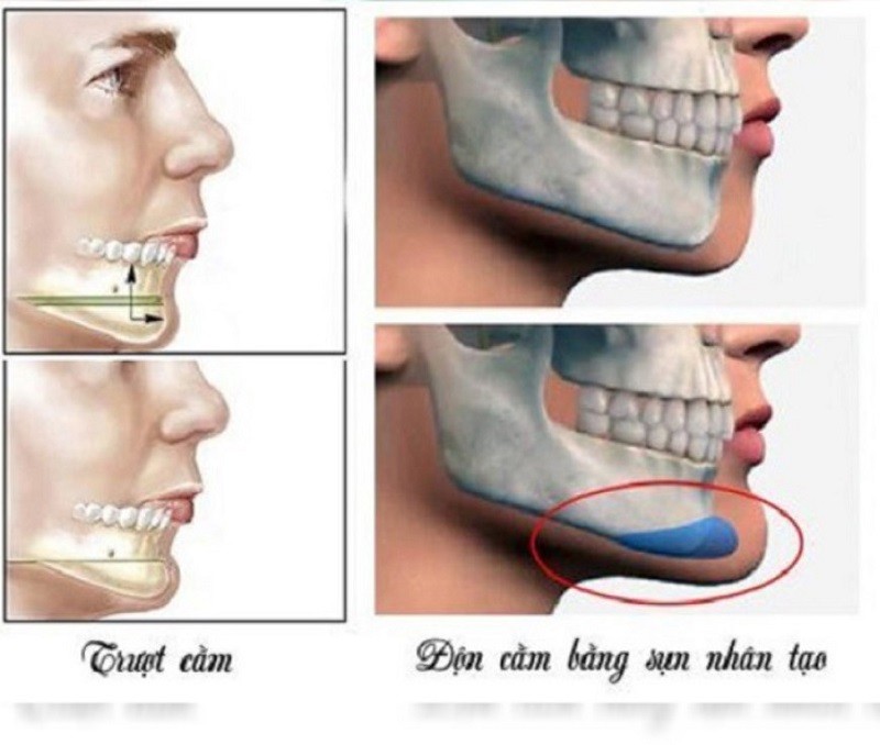 Hình ảnh mô phỏng sự khác biệt giữa trượt cằm và độn cằm