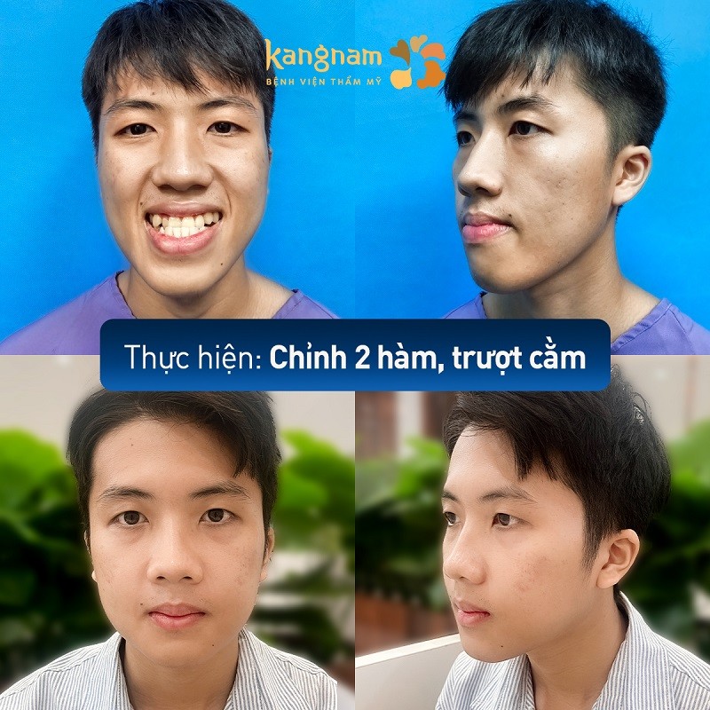 Thực hiện trượt cằm tại địa chỉ thẩm mỹ uy tín sẽ đảm bảo an toàn và hiệu quả cao
