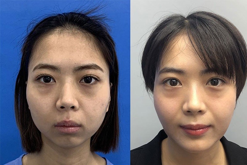 Trượt cằm giúp thay đổi diện mạo tối ưu