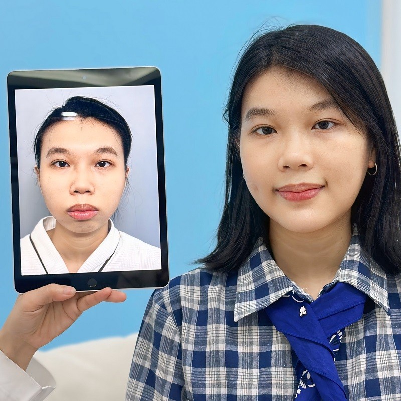 Nên lựa chọn địa chỉ thẩm mỹ uy tín để tránh gây biến chứng cằm lệch