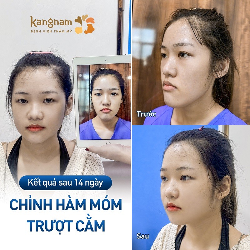 Trượt cằm tự thân duy trì được hiệu quả lâu dài