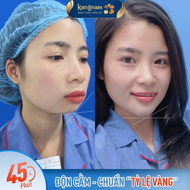 Độn cằm dùng chất liệu nhân tạo