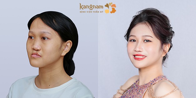 Người lớn bị hở hàm ếch có thể cải thiện chức năng và thẩm mỹ