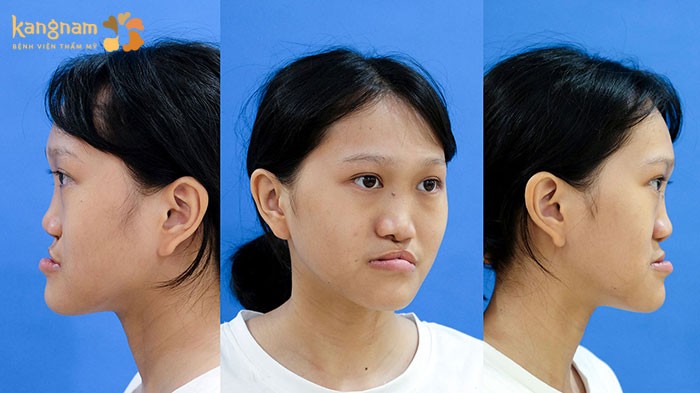 Người hở hàm ếch gặp khó khăn khi giao tiếp và tính thẩm mỹ