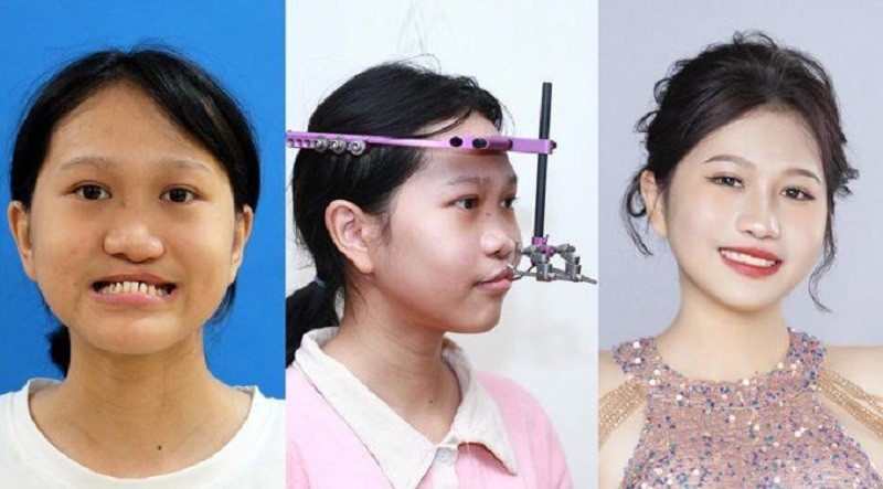 Trần Xuân Mai thí sinh Hành Trình Lột Xác (Mùa 6) được khắc phục di chứng hở hàm ếch miễn phí