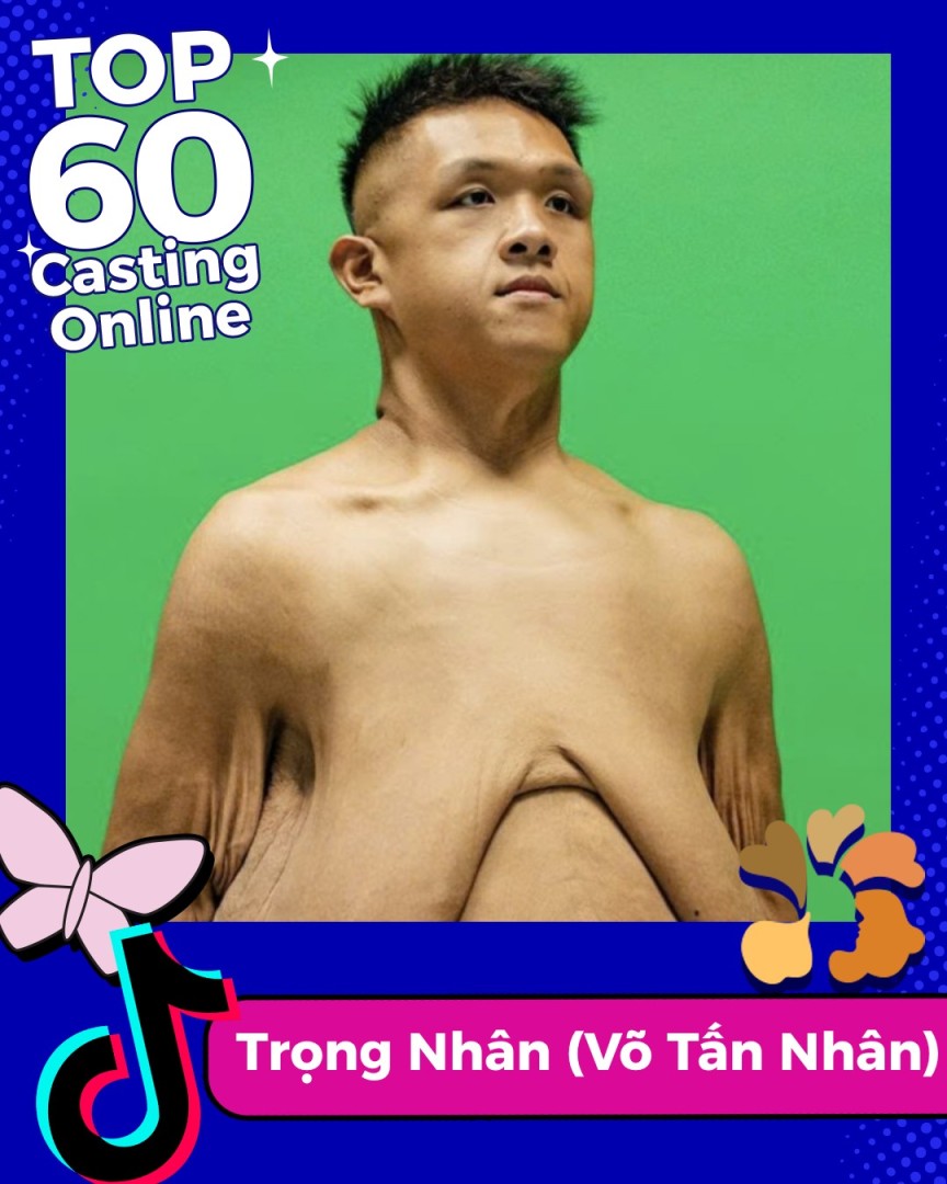 Tình trạng da thừa của Trọng Nhân hiện tại
