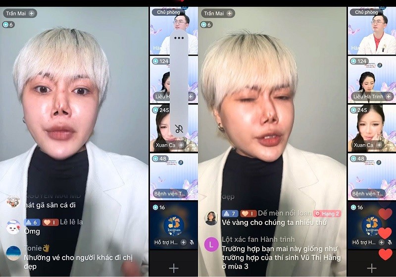 Gương mặt Quỳnh Mai bị biến dạng sau 5 lần thẩm mỹ lỗi