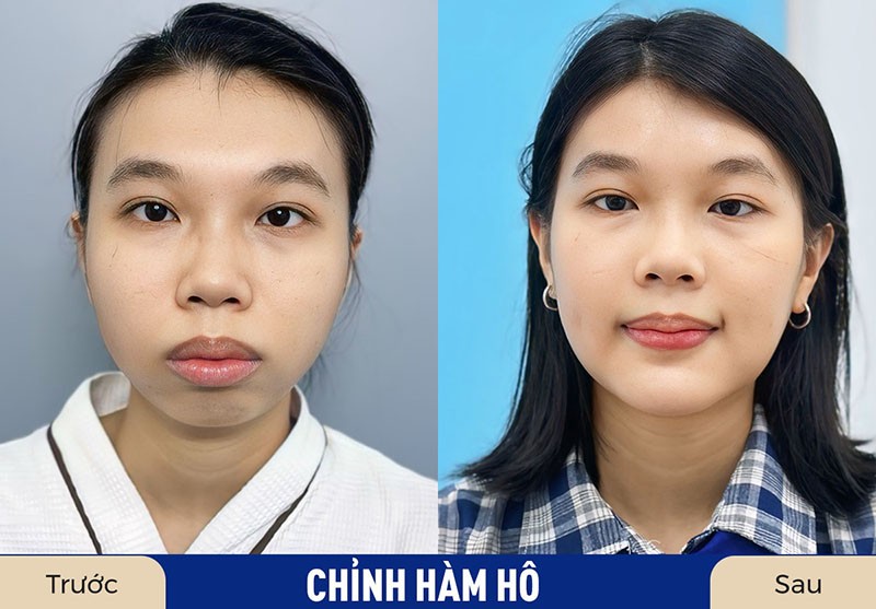 Khách hàng chỉnh hàm hô hồi phục nhanh chóng