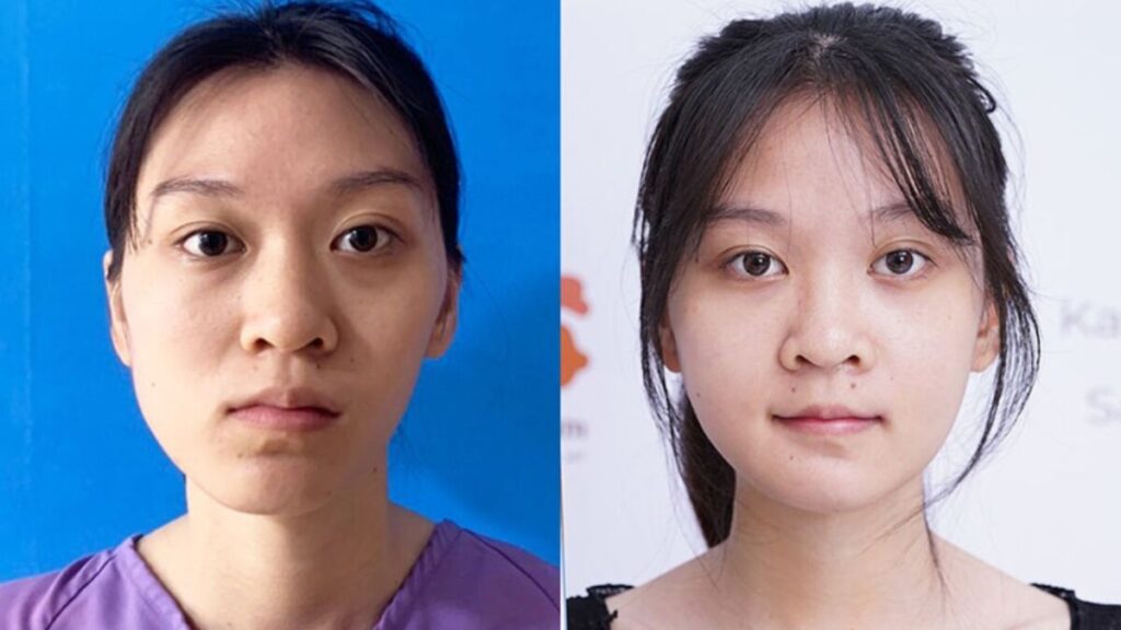 Chỉnh hàm lệch bao nhiêu tiền? Cập nhật giá mới nhất