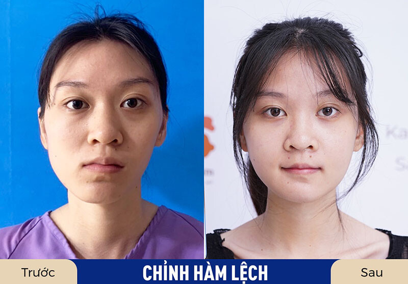 Khách hàng chỉnh hàm lệch