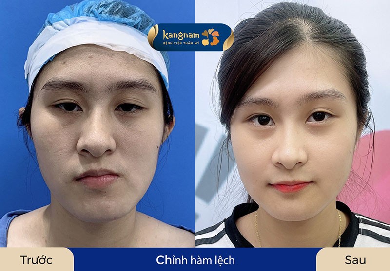 Đường nét khuôn mặt rõ ràng, không còn méo lệch