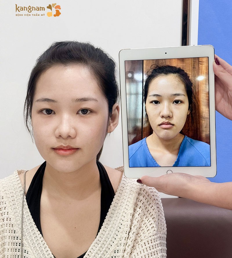 Tái khám đúng hẹn giúp theo dõi tiến độ lành thương và xử lý sớm các dấu hiệu bất thường