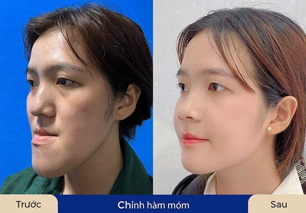 ít đau và hồi phục nhanh