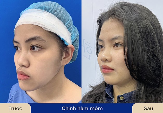 Phẫu thuật hàm móm hiện đại mang lại kết quả thẩm mỹ cao