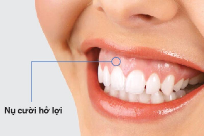 Cười hở lợi nhẹ nướu (lợi) lộ ra khoảng 3mm
