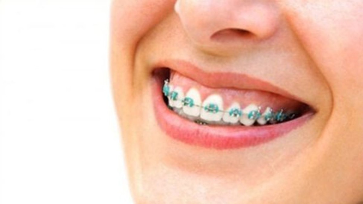 Cười hở lợi niềng răng có hết không hay phải phẫu thuật?