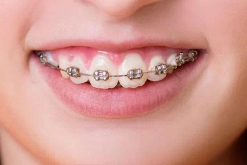Niềng răng có thể cải thiện tình trạng cười hở lợi