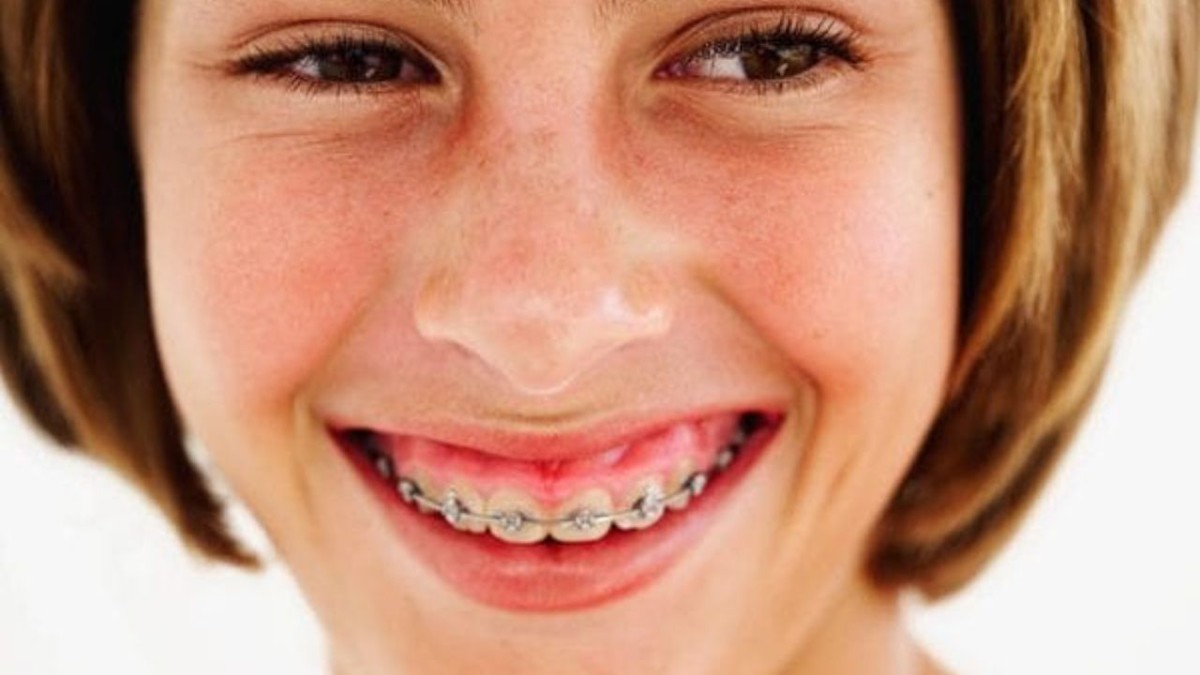 Giải đáp: Cười hở lợi có nên niềng răng không