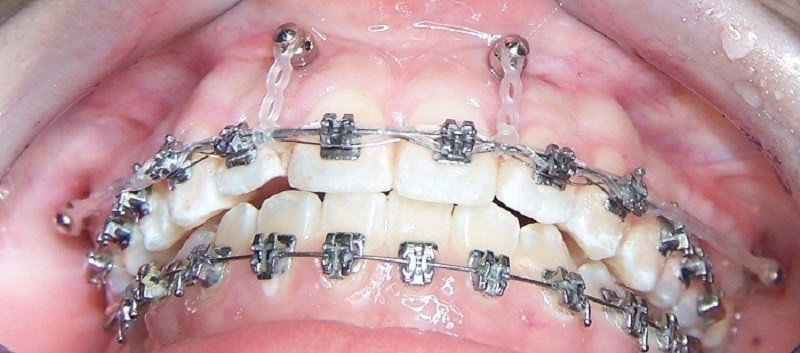 Đánh lún chữa cười hở lợi dùng dây cung chuyên biệt