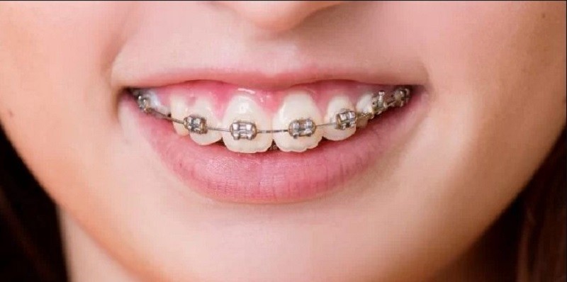 Phương pháp đánh lún sẽ giúp khắc phục tình trạng cười hở lợi không quá nặng