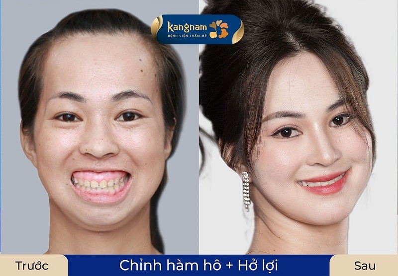 Phẫu thuật chỉnh hàm phù hợp với trường hợp <a href=