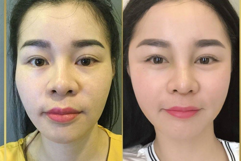Tình trạng sưng tấy sau độn thái dương sẽ hết sau vài ngày