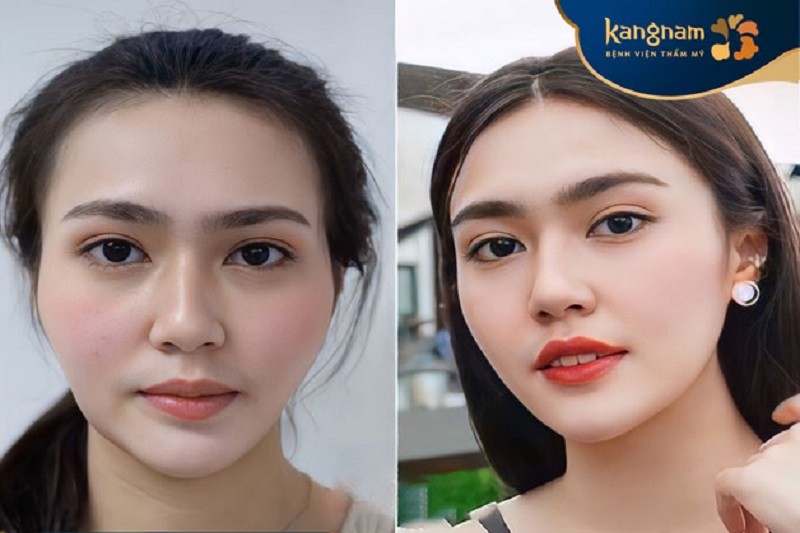 Những người có cơ địa bình thường sẽ nhanh phục hồi hơn