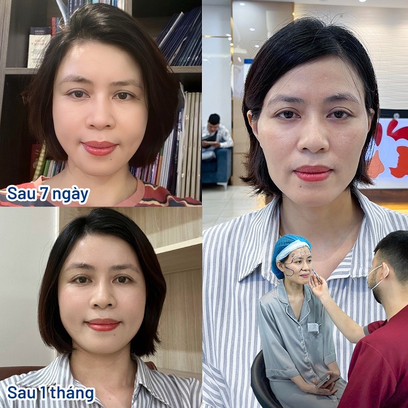 Sau khi hết sưng tấy, vùng thái dương sẽ ổn định và đẹp tự nhiên