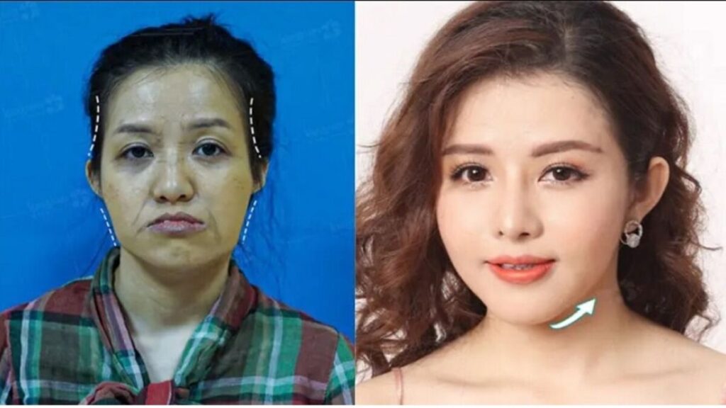 Độn thái dương được bao lâu? cần lưu ý điều gì