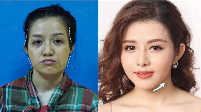 Phương pháp độn thái dương có thể duy trì hiệu quả lâu dài