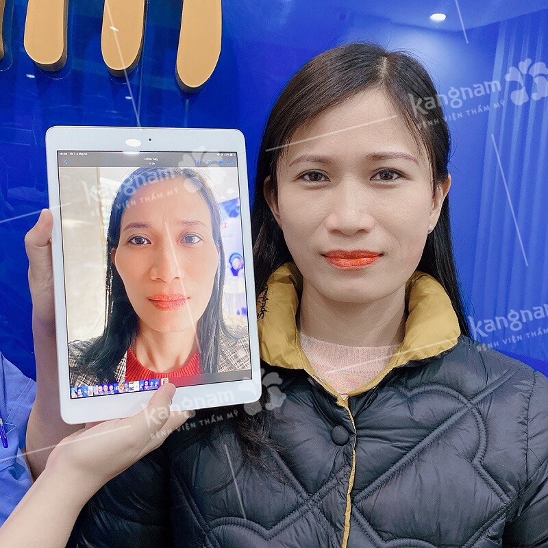 Tùy vào phương pháp thực hiện độn thái dương
