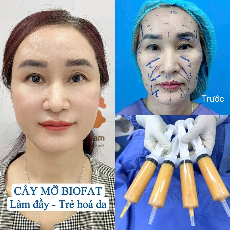 Cấy mỡ tự thân không lo đào thải