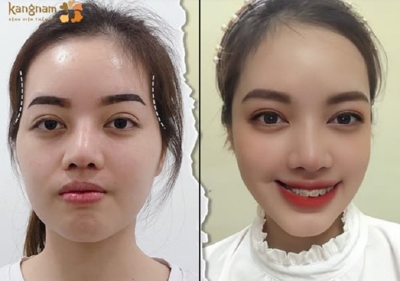 Thực hiện độn thái dương tái cơ sở thẩm mỹ uy tín giúp khách hàng đạt kết quả tốt nhất