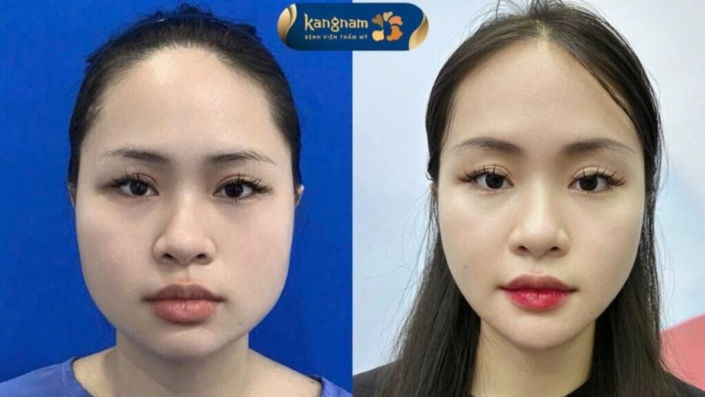 Phẫu thuật gọt hàm bao lâu hồi phục? các mốc thời gian cụ thể