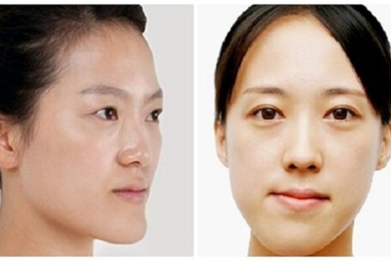 Biểu hiện khuôn mặt mất cân đối do <a href=