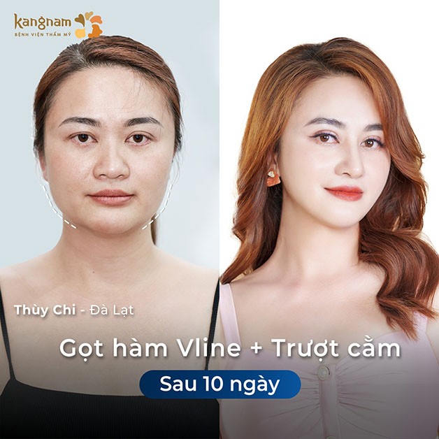 Khách hàng gọt hàm sau 10 ngày đã có kết quả ổn định cơ bản
