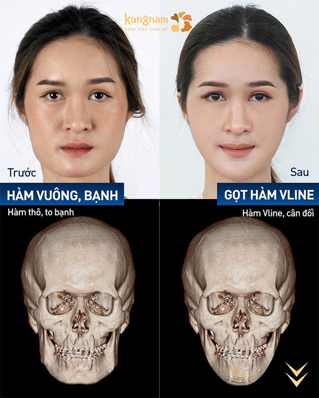 Gọt hàm vuông loại bỏ phần góc hàm thô, bạnh