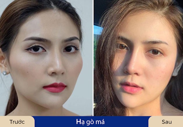 Quá trình hạ gò má ứng dụng công nghệ hiện đại