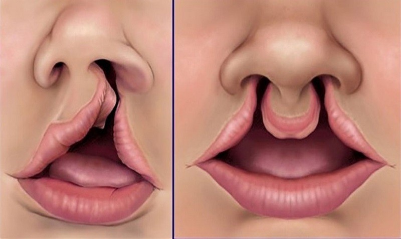 Dị tật hở hàm ếch có thể điều trị khỏi hoàn toàn