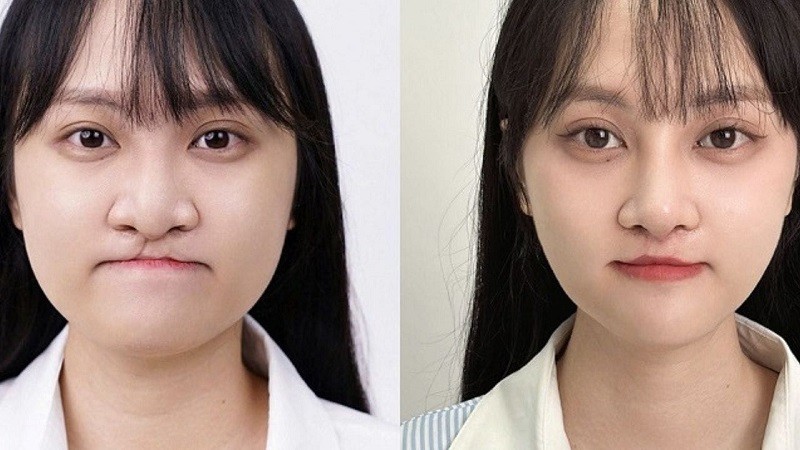 Khi trưởng thành phẫu thuật thẩm mỹ giúp chỉnh hình dị tật hở hàm ếch, đạt tính thẩm mỹ tốt hơn