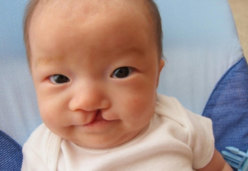 Những trẻ bị hở hàm ếch có nguy cơ mắc các bệnh về hô hấp