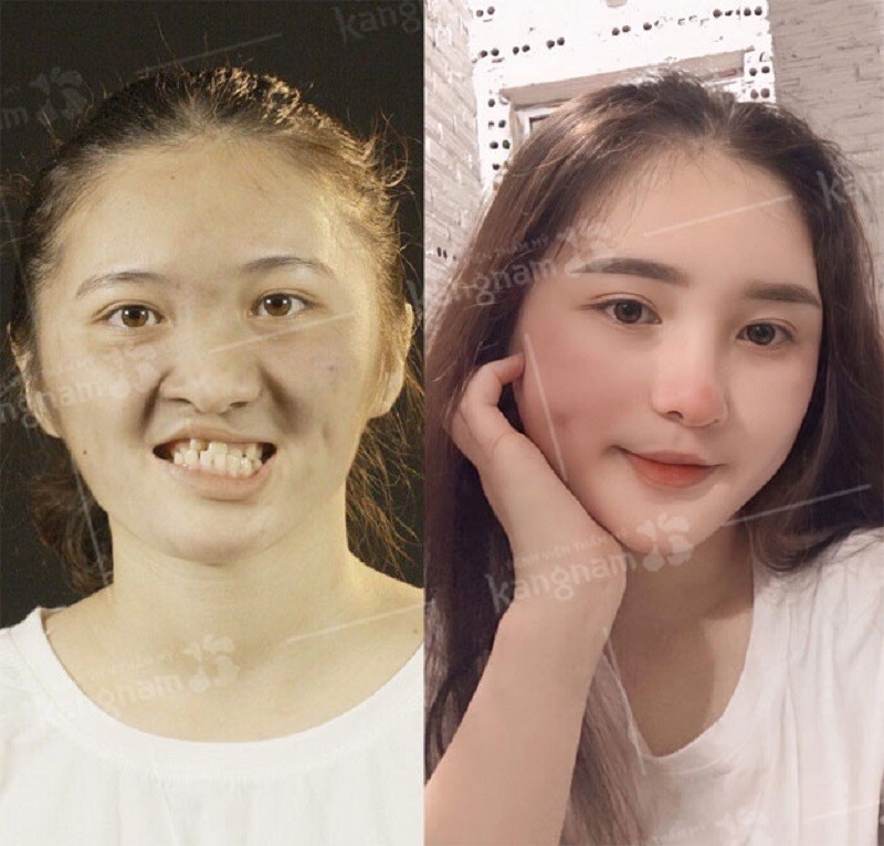 Phẫu thuật chỉnh hình hàm ếch ở độ độ trưởng thành