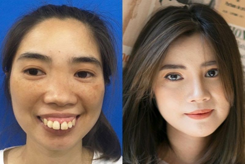 Sự khác biệt rõ rệt trước và sau phẫu thuật hàm hô