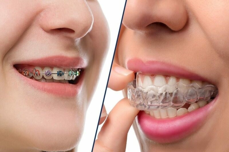 Hô do răng khi niềng sẽ giúp gương mặt thanh thoát hơn