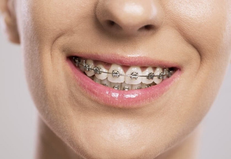 Kết hợp niềng răng và nhổ răng sẽ tạo điều kiện cho các răng di chuyển