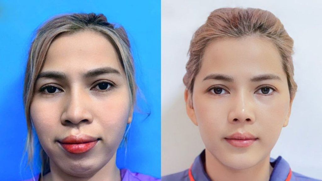 Phẫu thuật hàm hô có ảnh hưởng gì không? bạn cần lưu ý điều gì