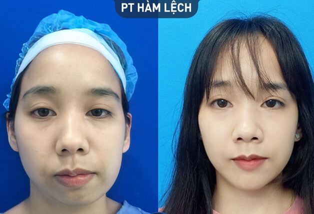 Chỉnh hàm lệch toàn diện