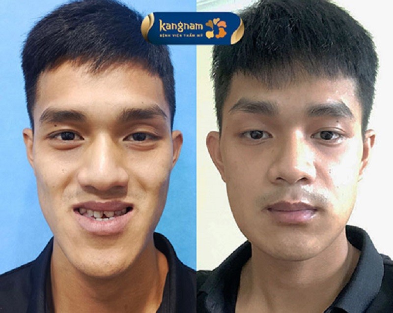 Biến chứng xảy ra khi kỹ thuật phẫu thuật không an toàn
