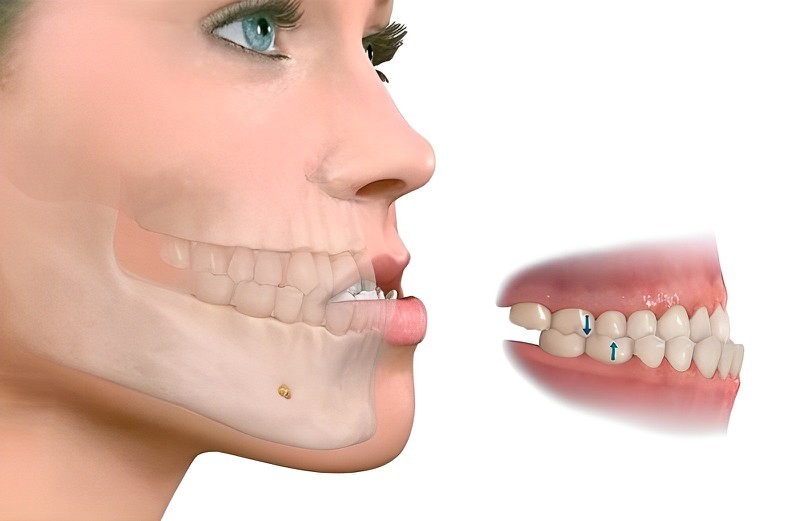 Phẫu thuật chỉnh sửa tình trạng hàm móm